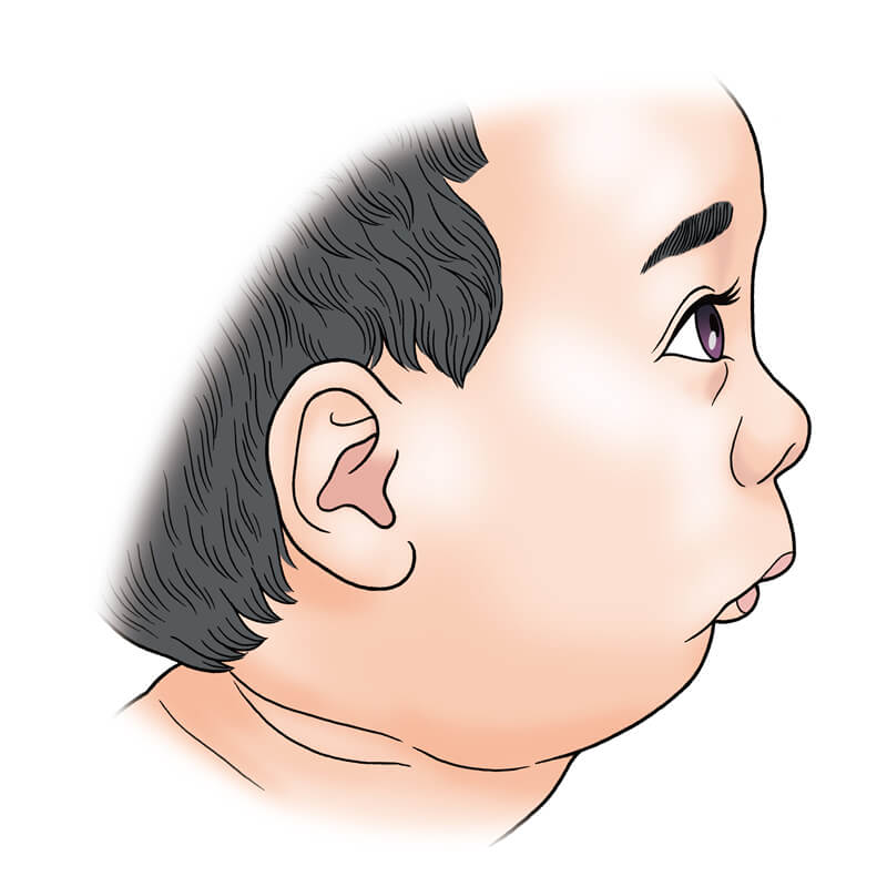 生まれつきの顎の変形 小顎症 顔面の非対称 一般社団法人 日本頭蓋顎顔面外科学会