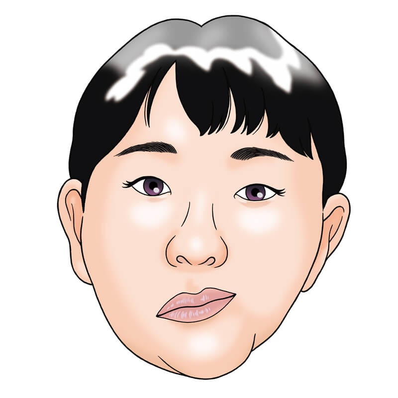 生まれつきの顎の変形 小顎症 顔面の非対称 一般社団法人 日本頭蓋顎顔面外科学会