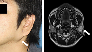 耳 下 腺 腫瘍